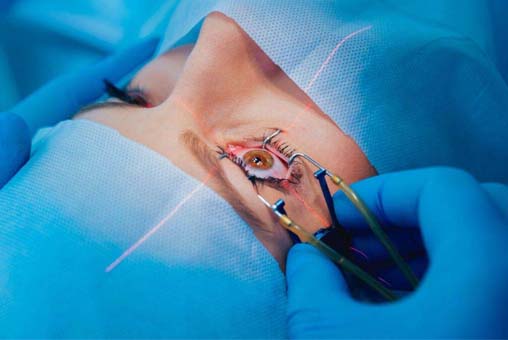 Anterior Segment Surgery