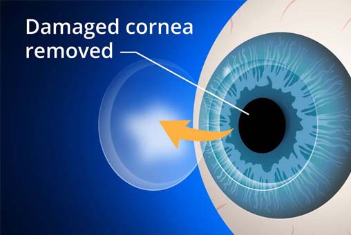 Anterior Segment Surgery