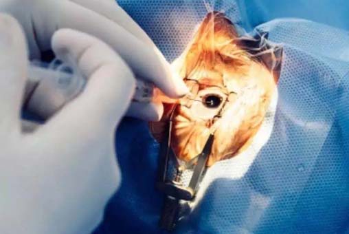 Anterior Segment Surgery